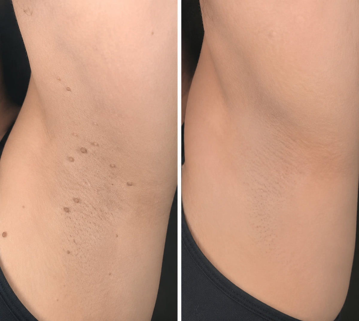 PURESHADE® Maximum Strength Wart Remover Patches 💧 Szemölcsök, talpi szemölcsök és bőrkinövések célzott ápolására | Egyszerű otthoni használat