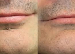 PURESHADE® Maximum Strength Wart Remover Patches 💧 Szemölcsök, talpi szemölcsök és bőrkinövések célzott ápolására | Egyszerű otthoni használat