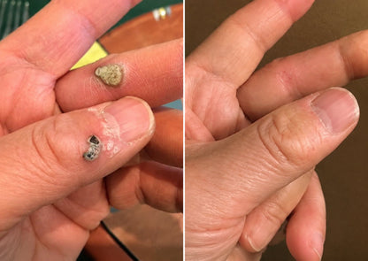 PURESHADE® Maximum Strength Wart Remover Patches 💧 Szemölcsök, talpi szemölcsök és bőrkinövések célzott ápolására | Egyszerű otthoni használat