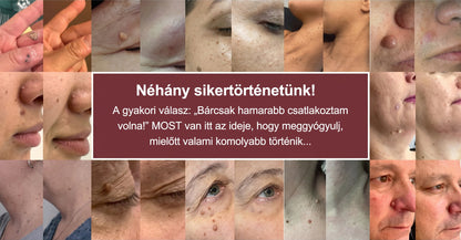 PURESHADE® Maximum Strength Wart Remover Patches 💧 Szemölcsök, talpi szemölcsök és bőrkinövések célzott ápolására | Egyszerű otthoni használat