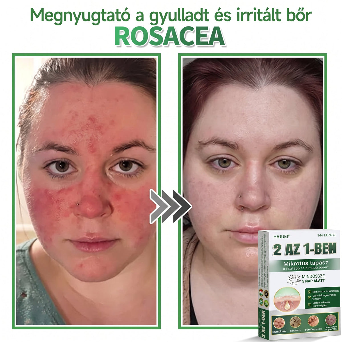 🇭🇺HAJUEI® ☺️ 2-az-1-ben Mikrotű & Hidrokoloid Tapasz | 🧪 Kiemelkedő Anyajegyek, Pattanások, Lapos Szemölcsök & Bőrkinövések Eltávolítója | Ráncok, Hegek & Bőrhibák Javítása | Láthatatlan Csillag Pattanástapasz Arcra & Testre | 144 db ✨