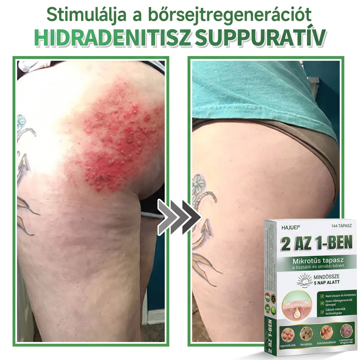 🇭🇺HAJUEI® ☺️ 2-az-1-ben Mikrotű & Hidrokoloid Tapasz | 🧪 Kiemelkedő Anyajegyek, Pattanások, Lapos Szemölcsök & Bőrkinövések Eltávolítója | Ráncok, Hegek & Bőrhibák Javítása | Láthatatlan Csillag Pattanástapasz Arcra & Testre | 144 db ✨